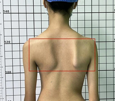 Asesiad Scoliosis Cynhwysfawr: Deall, Adnabod, a Mynd i'r Afael ag Iechyd Sbinol