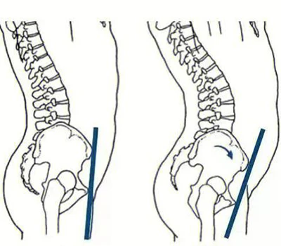 Asesiad Tilt Pelfig Blaenorol: Achosion, Risgiau, Dulliau Gwerthuso, a Chymwysiadau Masnachol