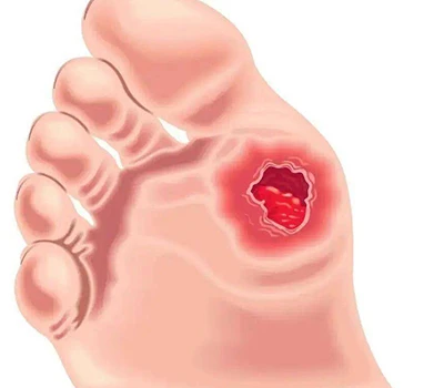 Asesiad Traed Diabetig: Mewnwelediad Clinigol, Rheoli Risg, a Chyfleoedd Masnachol