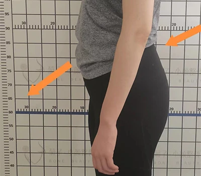 Asesiad Tilt Pelvic Posterior: Mewnwelediad Clinigol, Gwerth Masnachol, a Chymwysiadau Cywirol