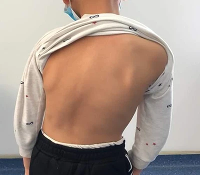 Sgrinio a Rheoli Scoliosis: Sut Mae Sganiwr Corff Xianku 3D yn Cynorthwyo Ceiropractyddion