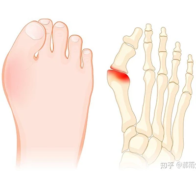 Hallux Valgus: Arweinlyfr Gwyddoniaeth Cyflawn