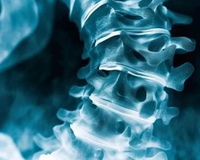 Sgrinio Scoliosis AI Ac Olrhain Aliniad Sbinol: Ateb Sgrinio Iechyd 3D Doethach Ar Gyfer Ysgolion...