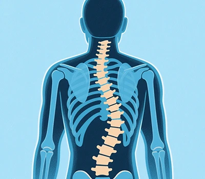Scoliosis: Sganiwr Corff 3D Xianku, 3D+AI, Atal a Chywiro Scoliosis