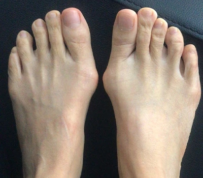 Mesur Hallux Valgus: Pam mae sganwyr 3D yn drech na chlinigwyr ac ysbytai