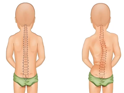 Dull Sgrinio Scoliosis Newydd: AI & Asgwrn Cefn Digidol 3D