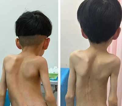 Iechyd Sbinol: Rôl Technoleg Sganio Corff 3D mewn Asesu Scoliosis A Thrawsnewid y Farchnad