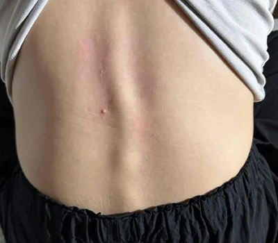 Dadansoddiad Cynhwysfawr o Scoliosis: Deall y Cyflwr A'r Arloesiadau Technolegol mewn Asesu a Rheoli