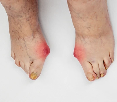 Atal Traed Diabetig - Sut Mae Sganio 3D yn Galluogi Ymyrraeth Gynnar mewn Gofal Iechyd